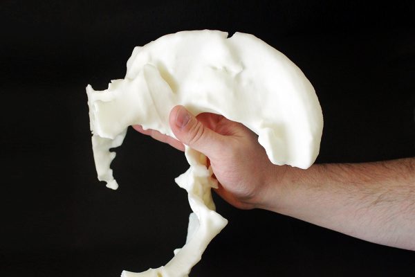 Biomodelo prequirúrgico